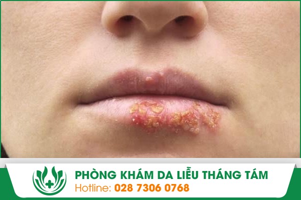 xăm môi nổi mụn nước