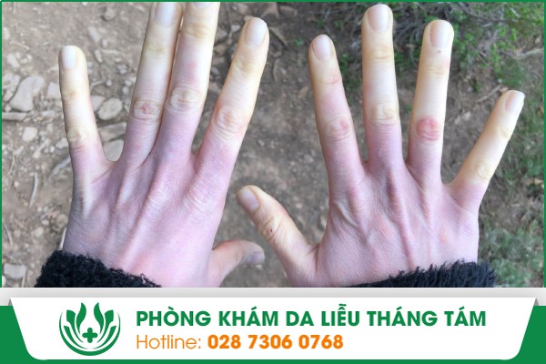 xơ cứng bì sống được bao lâu