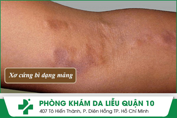 xơ cứng bì dạng mảng