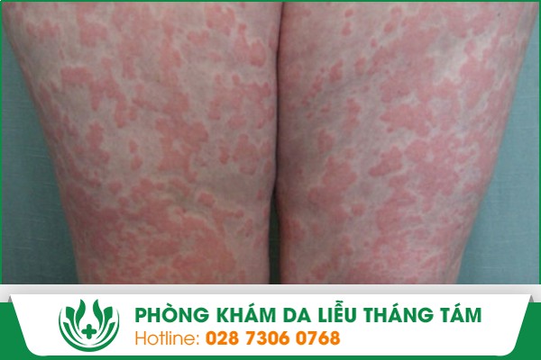 xơ cứng bì sống được bao lâu